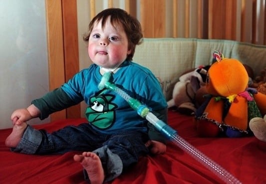 Boy with tracheostomy tube